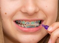 Klasické fixné strojčeky na zuby raz budú minulosťou. Foto: Gettyimages.com