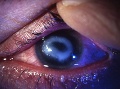 Oko pacienta s rozvinutou akantamébovou keratitídou, ktorá vznikla po nosení kontaktných šošoviek. (Z 19 pacientov 18 nosilo kontaktné šošovky). Oko pacienta bolo liečené transplantáciou rohovky. Foto: K. Peško