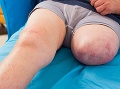 Mohli by riasy pomáhať pacientom, ktorým hrozí amputácia končatiny? Foto: Gettyimages.com