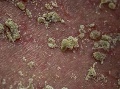 Koža postihnutá seboroickou dermatitídou pri pohľade cez mikroskop. Foto: Gettyimages.com