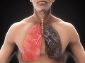 Zdravé pľúca verzus pľúca fajčiara. Foto: Gettyimages.com