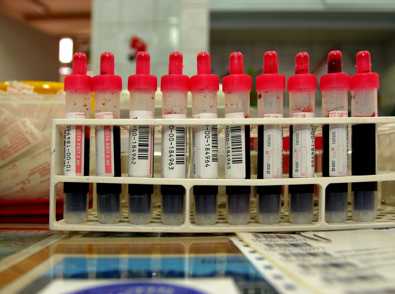 Na vyšetrenie anémie sa najčastejšie používa odber krvi.