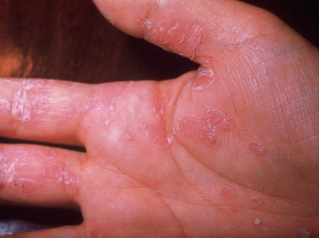 Psoriáza je nepríjemné kožné ochorenie, ktoré môže postihnúť kohokoľvek!