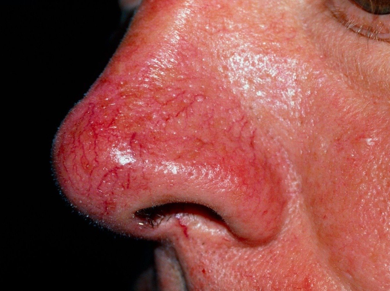 Rozacea často spôsobuje začervenanie alebo návaly sčervenania hlavne v oblasti líc, ale aj nosa, brady a čela.