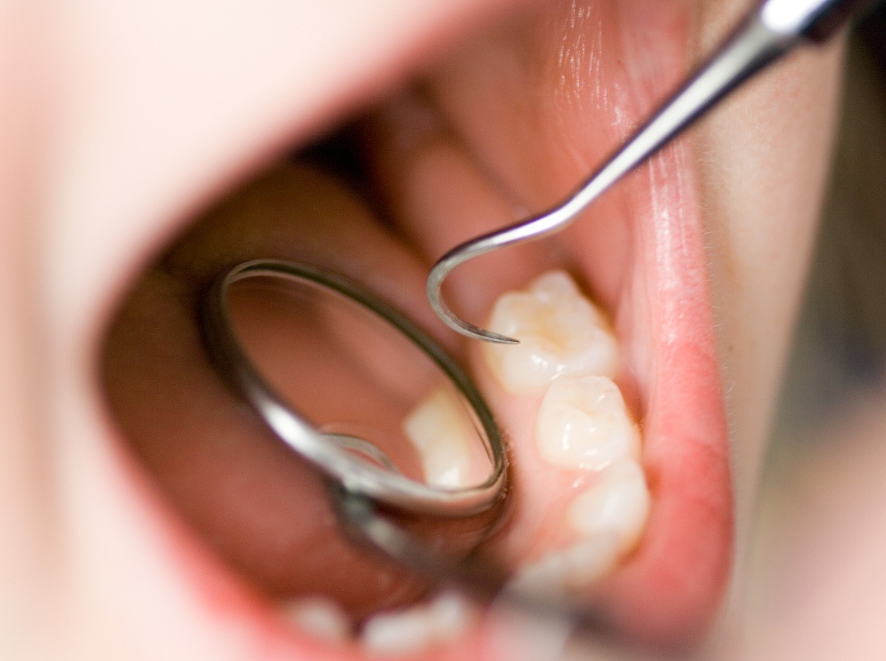 Slovenské deti majú jedny z najviac skazených zubov v Európe!