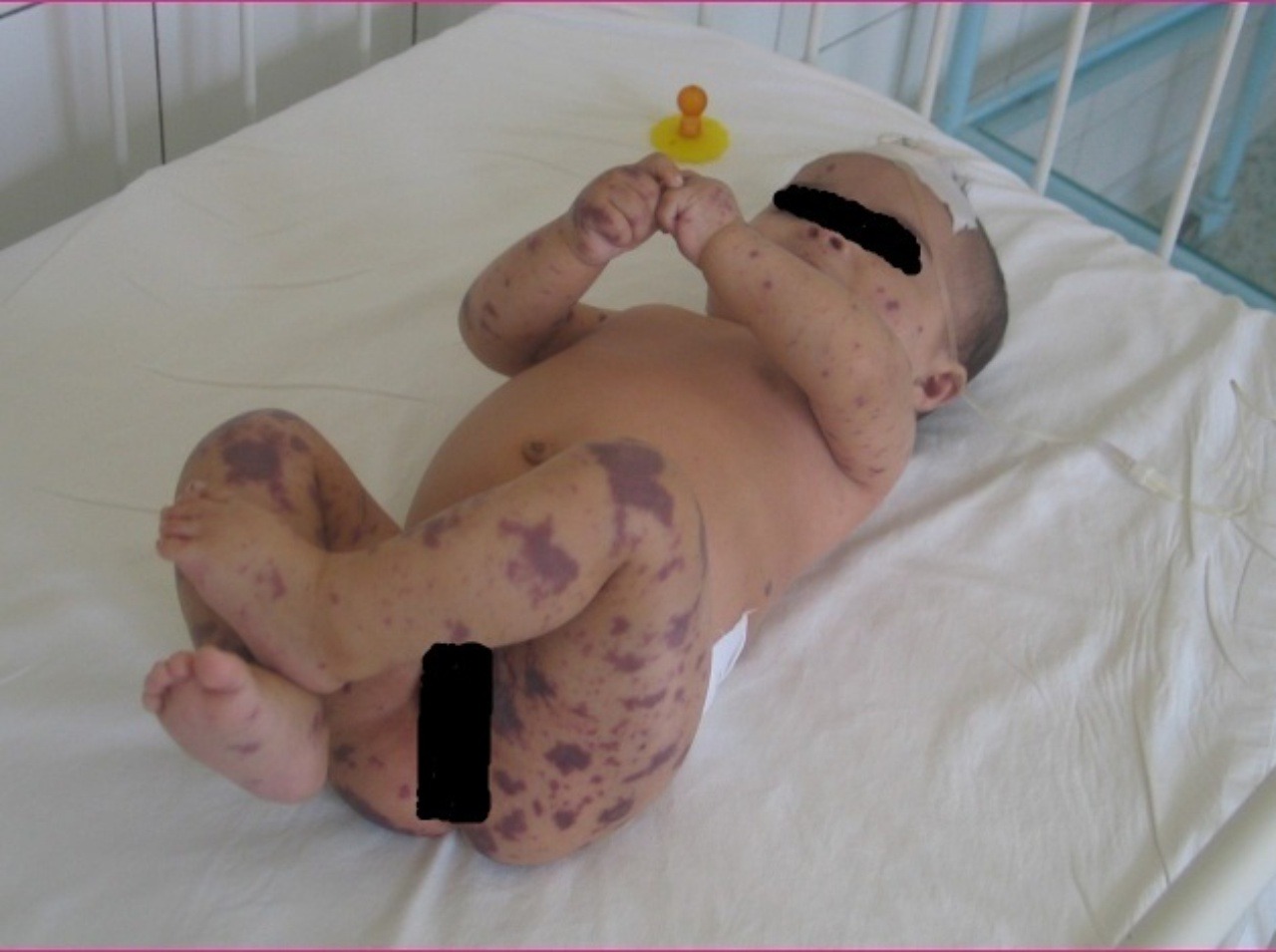 Bábätko postihnuté nebezpečnou baktériou Neisseria meningitis, známa ako meningokok.