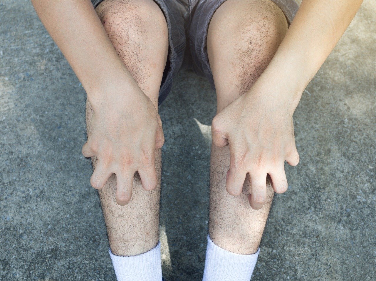 Žihlavka je nielen poruchou kože, ale aj imunitného systému. 
