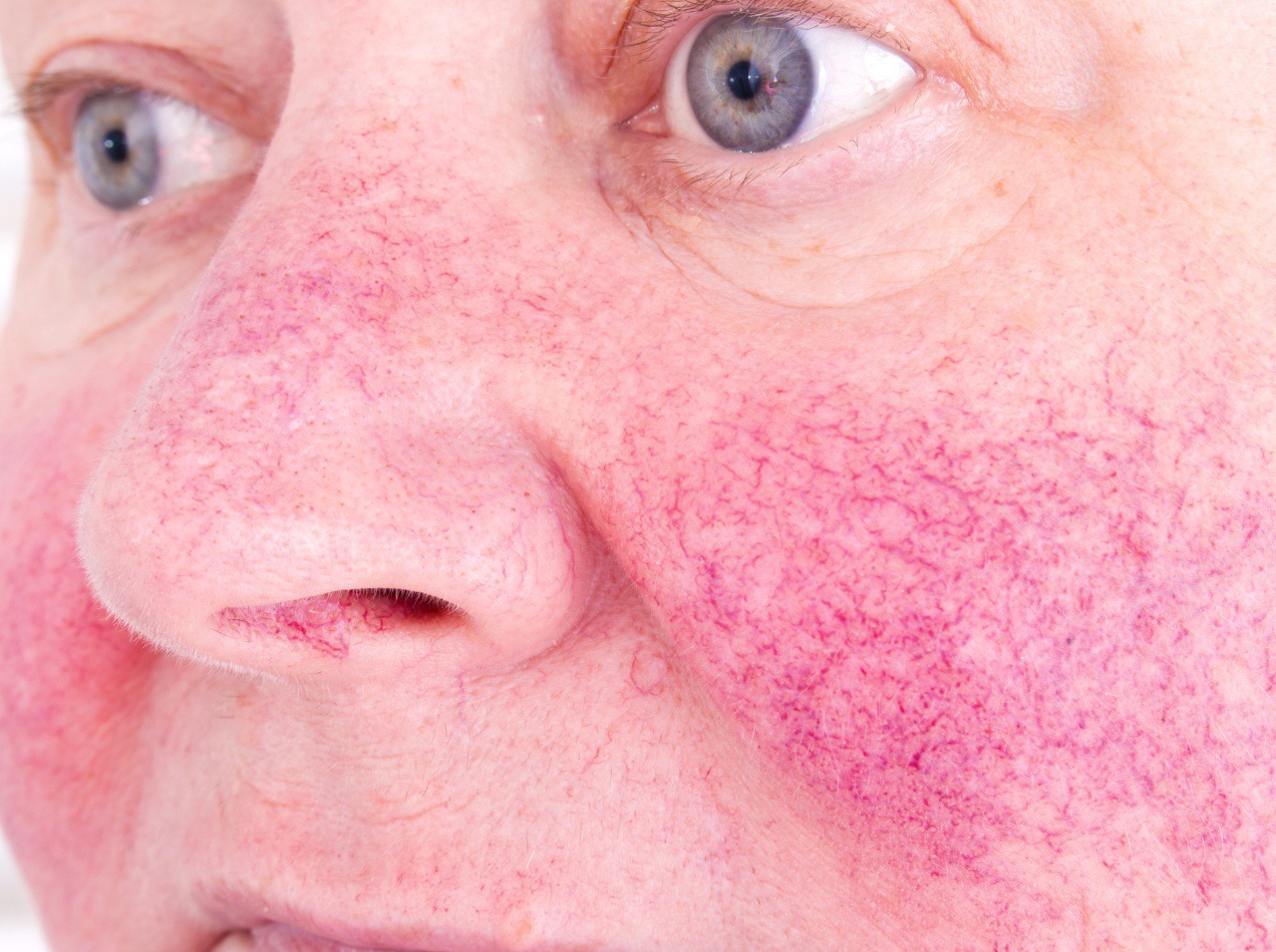 Rozšírené cievky na lícach či na nose ľudia často mylne považujú za popraskané.