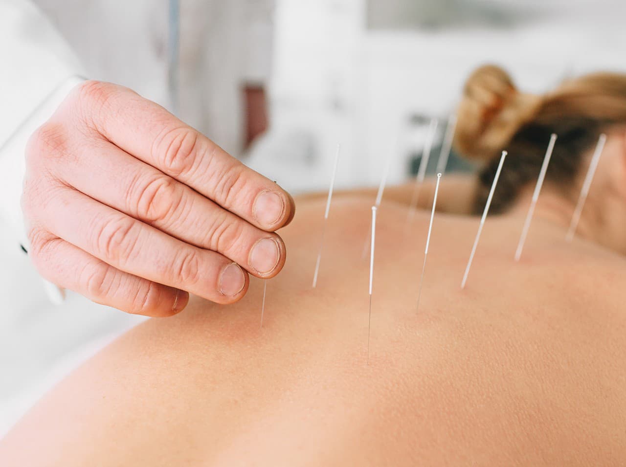 Akupunktúra má v tradičnej čínskej medicíne dôležité postavenie.