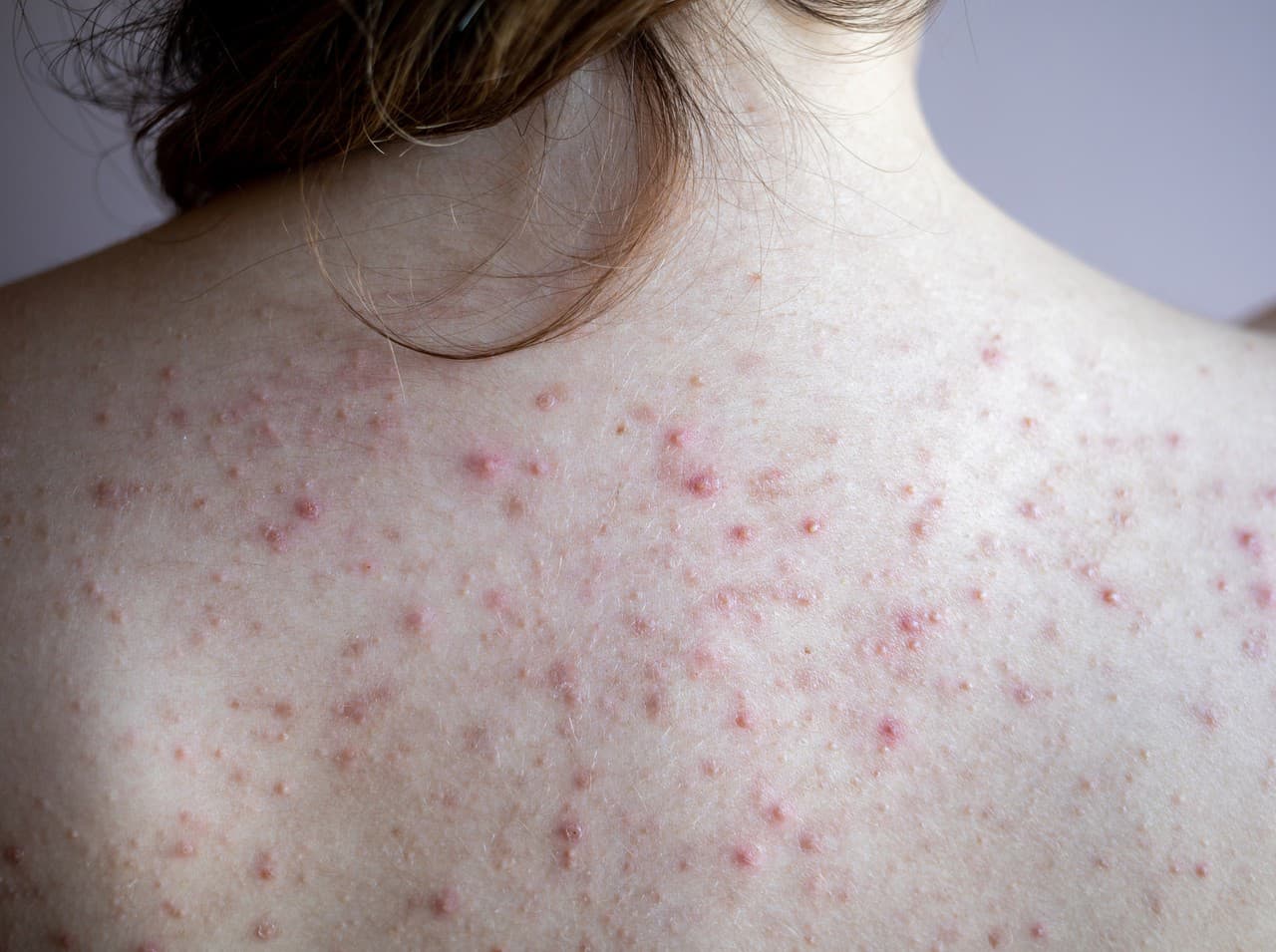 Približne polovica ľudí s akné na tvári má akné aj na chrbte.