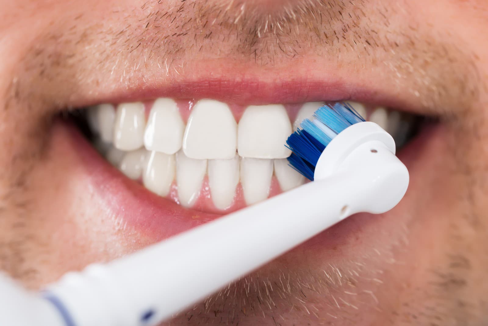Ako ODSTRÁNIŤ zubný KAMEŇ