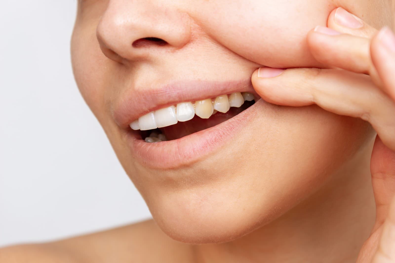 Zubnú sklovinu si dokáže chrániť remineralizačnými gélmi.