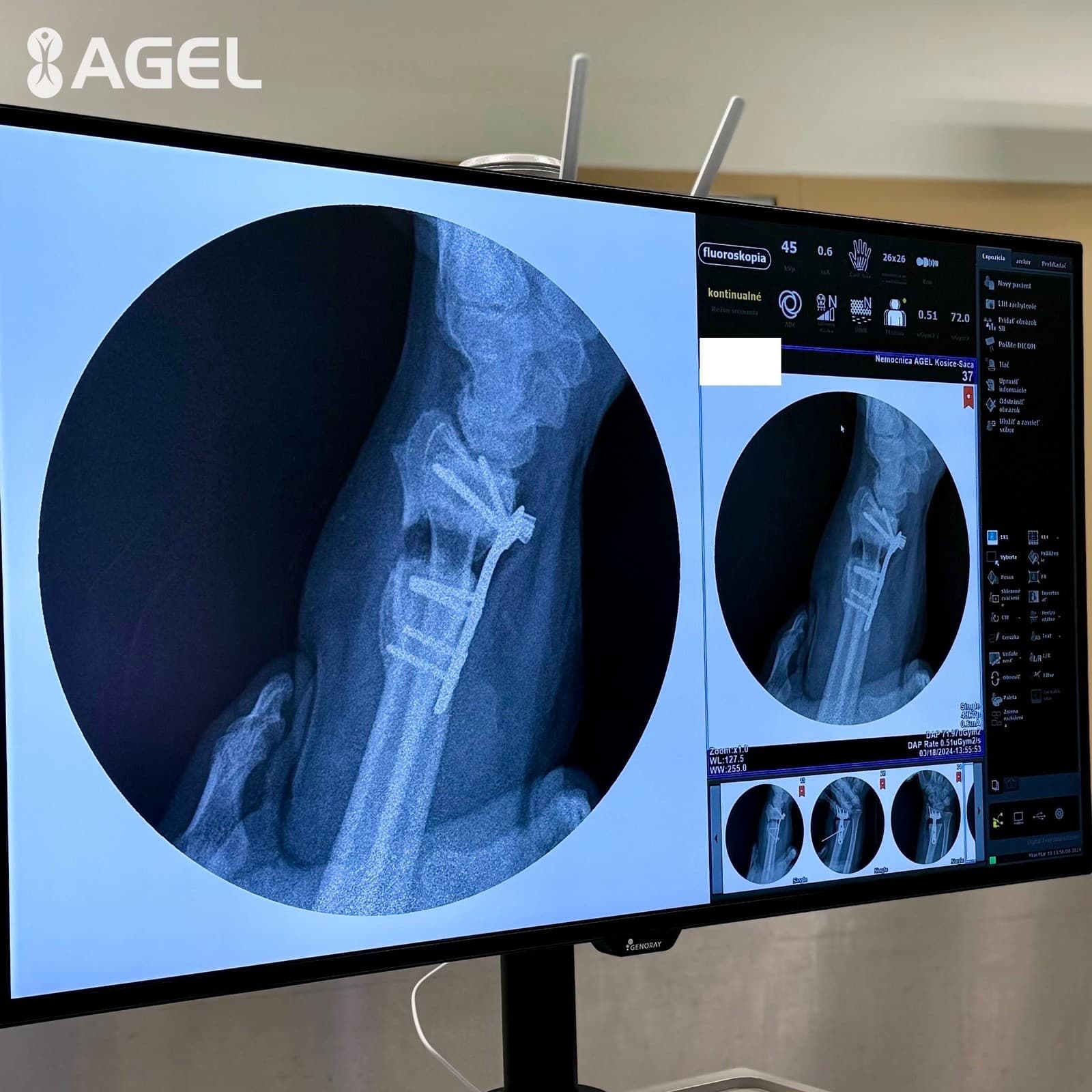 Korekcia kostnej deformity pomocou 3D plánovania v grafických programoch, finálny kontrolný RTG na operačnej sále