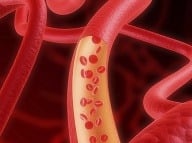 HDL je pre Vaše telo prospešný, pretože pomáha odstrániť cholesterol z tepien a chráni pred ich nebezpečným upchávaním (tzv. pláty). 