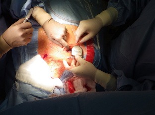 Takto vyzerá implantácia impulzogenerátora.