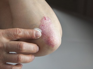 Odpoveďou na nepríjemnú psoriázu