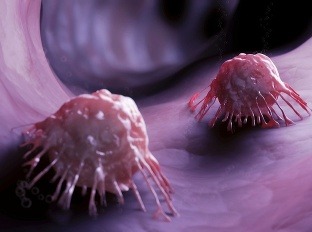 Rakovinové bunky napádajú telo.