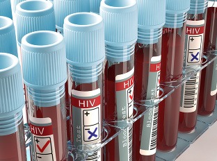HIV pacienti sú stigmatizovaní