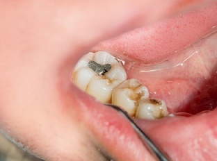 Slovenskí zubári budú používať