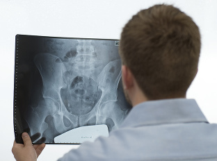 Veľký omyl o osteoporóze,