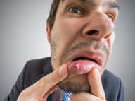 Čo ZABERÁ na biele VREDY v ústach? Choďte do KUCHYNE a zbavíte sa nepríjemných RÁN