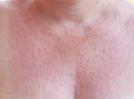 Alergia na slnko je hrôza: TOTO vážne nechcete!