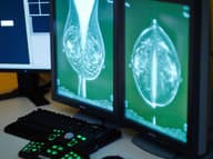 Preventívne sonografické vyšetrenia prsníkov sa rušia: Čo to znamená pre ženy a ako to bude po novom?