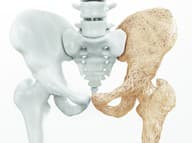 Na osteoporózu treba myslieť v mladšom veku: TOTO je kľúč k silným kostiam!