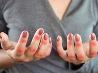 TOUTO chorobou trpí aj slávna Selena Gomez!