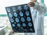 Takmer POLOVICA svetovej populácie trpí neurologickými poruchami: Najčastejšie sú tieto!