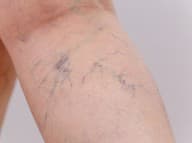 Tieto potraviny zaraďte do jedálnička: Môžu pomôcť predísť hlbokej žilovej trombóze