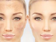 Jednoduché triky, ako zvládnuť hyperpigmentáciu, za ktoré vás dermatológ nevyhreší