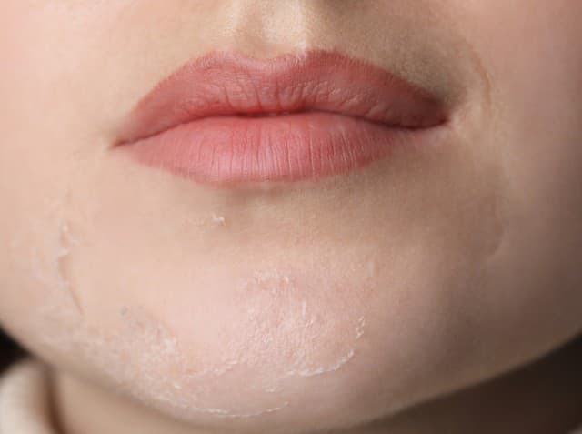 Prečo je pleť suchá, aj keď pravidelne používate hydratačný krém?