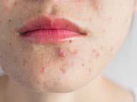 Prečo hormonálne akné vzniká aj po tridsiatke a čo naň skutočne zaberá? Čítajte
