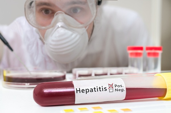 Vírusová hepatitída je zápalové