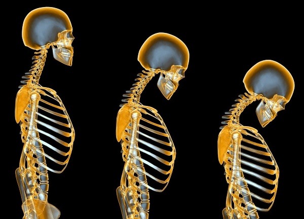 Každé 3 sekundy si niekto zlomí kosť kvôli osteoporóze. (Foto: profimedia.sk)