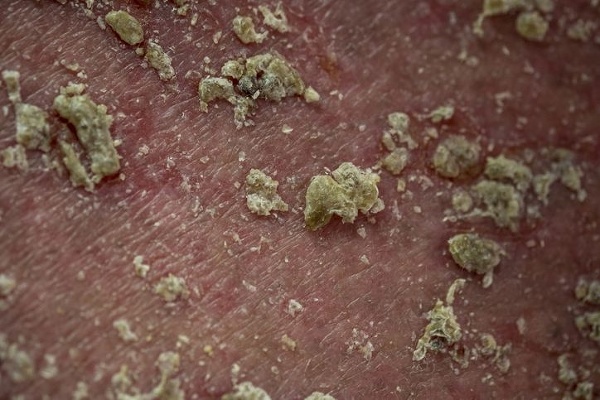 Koža postihnutá seboroickou dermatitídou pri pohľade cez mikroskop. Foto: Gettyimages.com