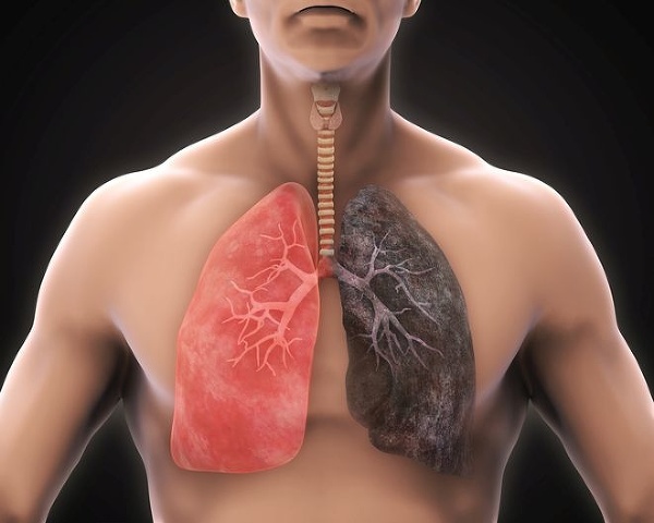 Zdravé pľúca verzus pľúca fajčiara. Foto: Gettyimages.com