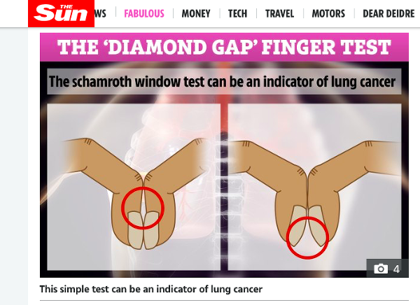 V prvom prípade, ak uvidíte medzeru medzi prstami, ide o dobré znamenie. Avšak, v prípade paličkových prstov sa medzera vytvára pro končekoch prstov, čo by mohol byť príznak ochorenia. (Foto: screenshot thesun.co.uk)