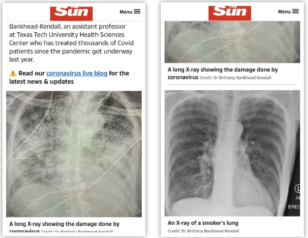 Prvá snímka ukazuje poškodené pľúca novým koronavírusom a na druhej sú pľúca tuhého fajčiara. (FOTO: screenshot thesun.co.uk)