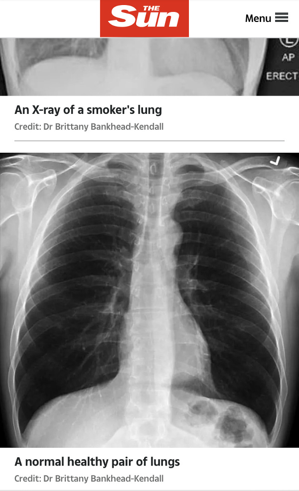 Takto vyzerajú zdravé pľúca. (FOTO: screenshot thesun.co.uk)