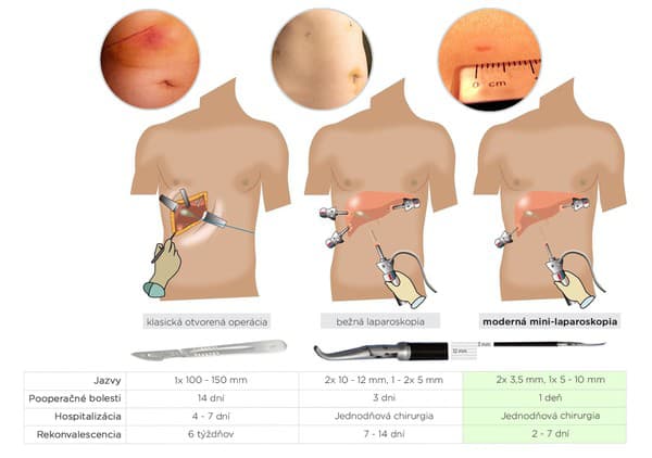 Mini-laparoskopia: Najšetrnejšia forma operácie