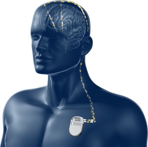 Neurostimulátor v tele. 